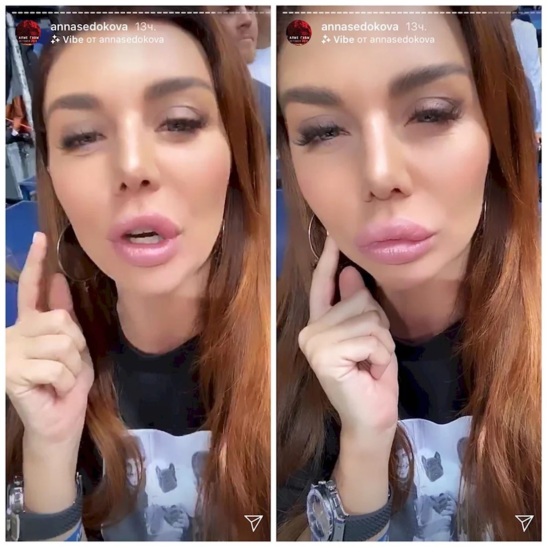 Анна Седокова после пластики