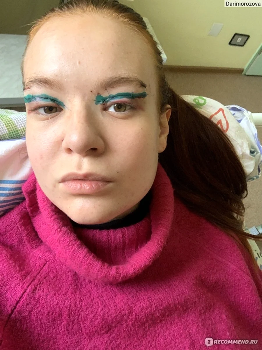 Блефаропластика до и после
