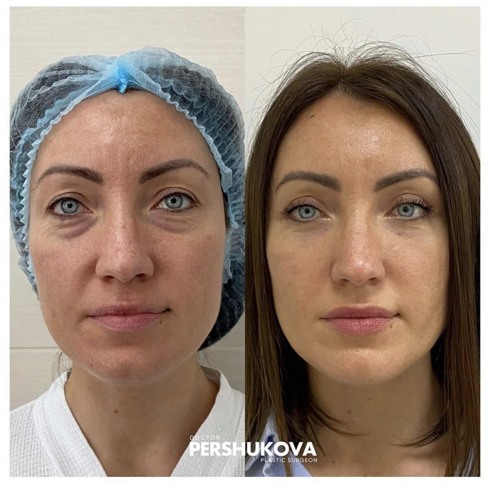 Блефаропластика пластика нижних век