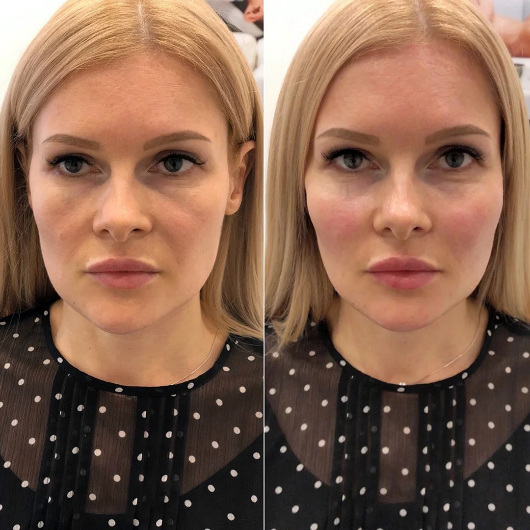 Ботокс Full face до и после