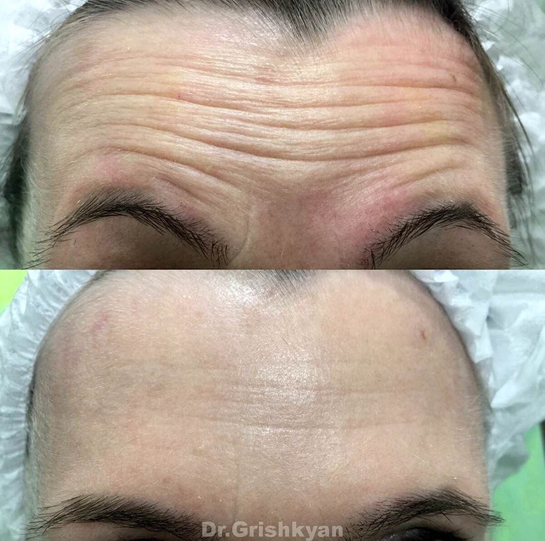 Ботокс лоб межбровье глаза