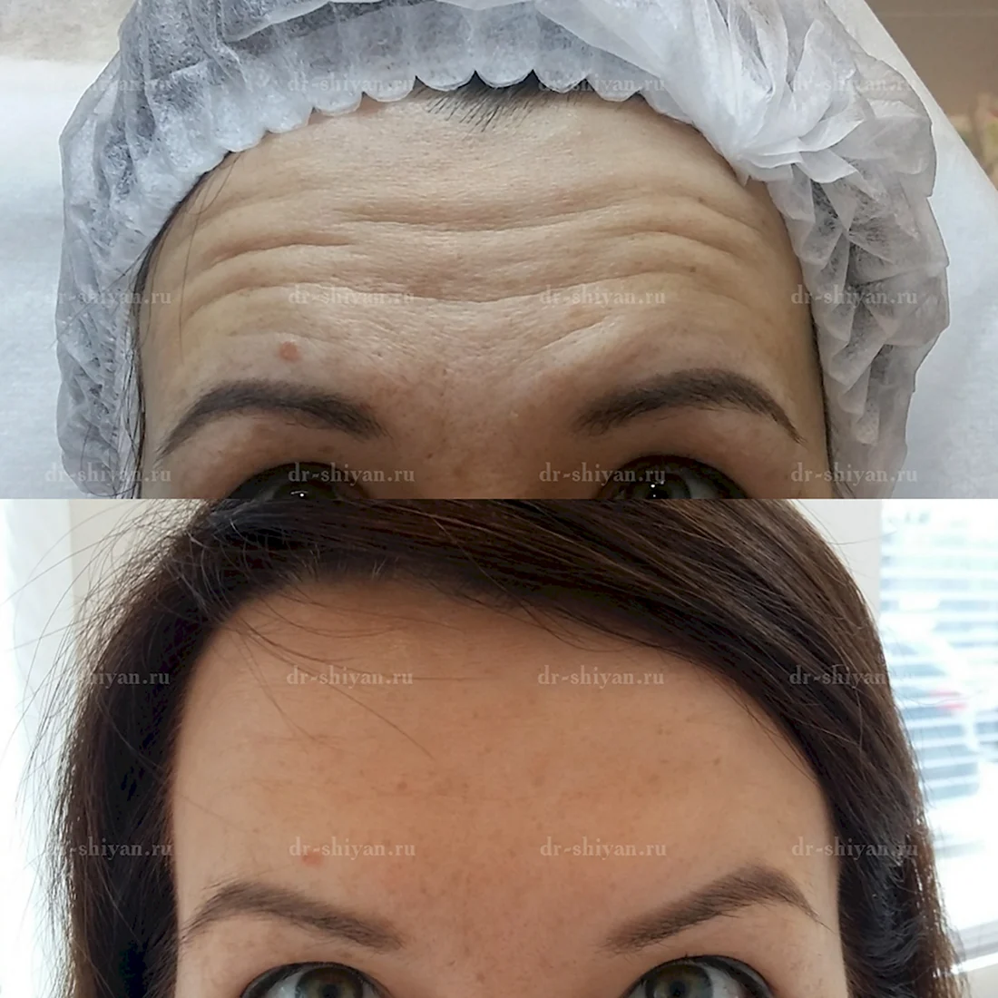 Ботокс межбровье