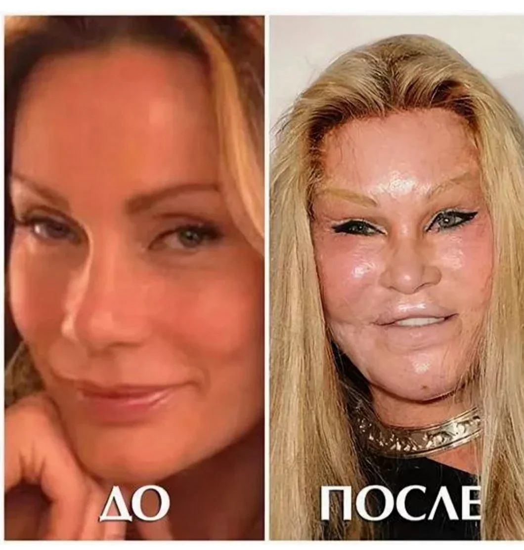 Джослин Вильденштейн до пластики