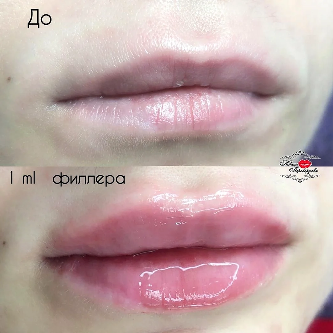 Филлеры для губ на основе гиалуроновой