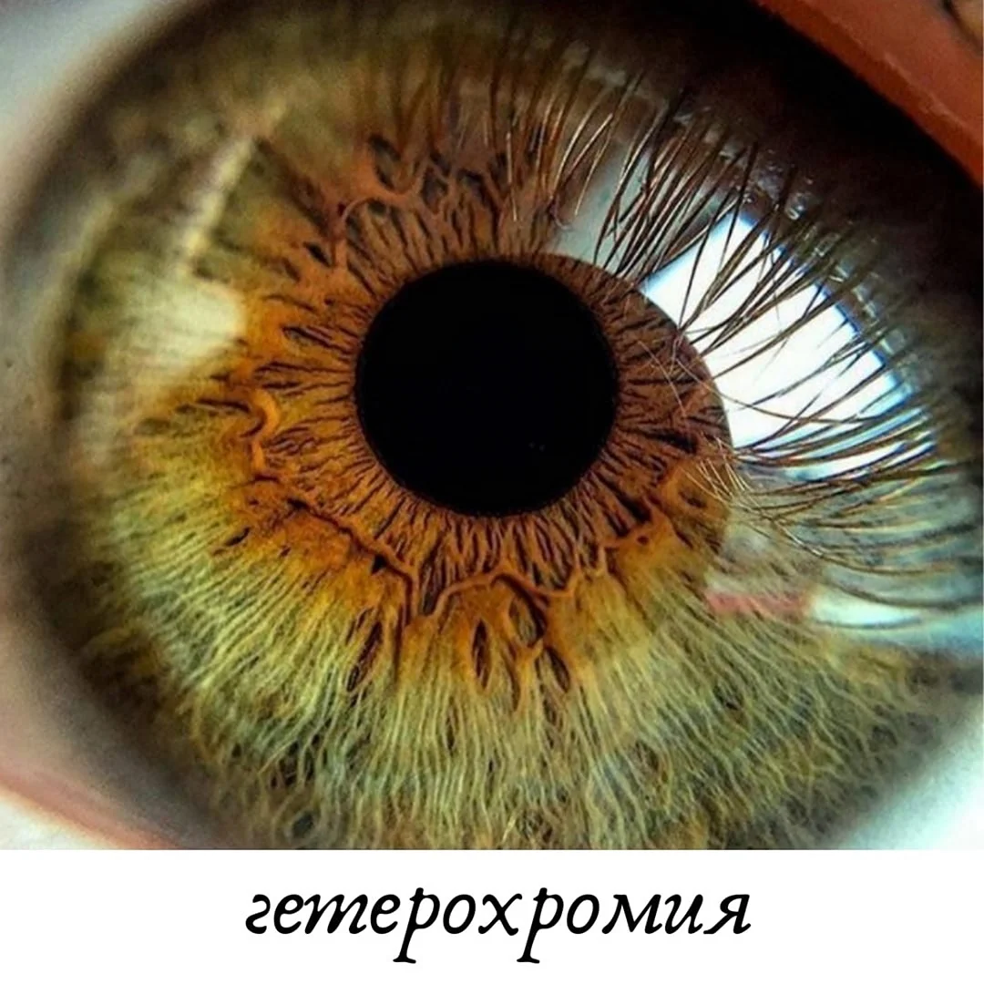 Гетерохромия Радужки