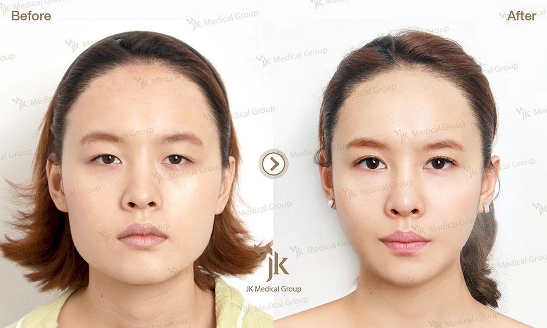 JK пластическая хирургия Корея