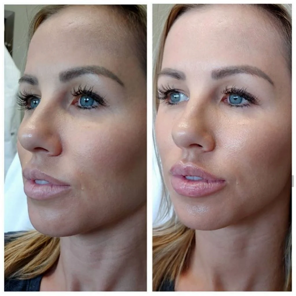 Juvederm Ultra XC.