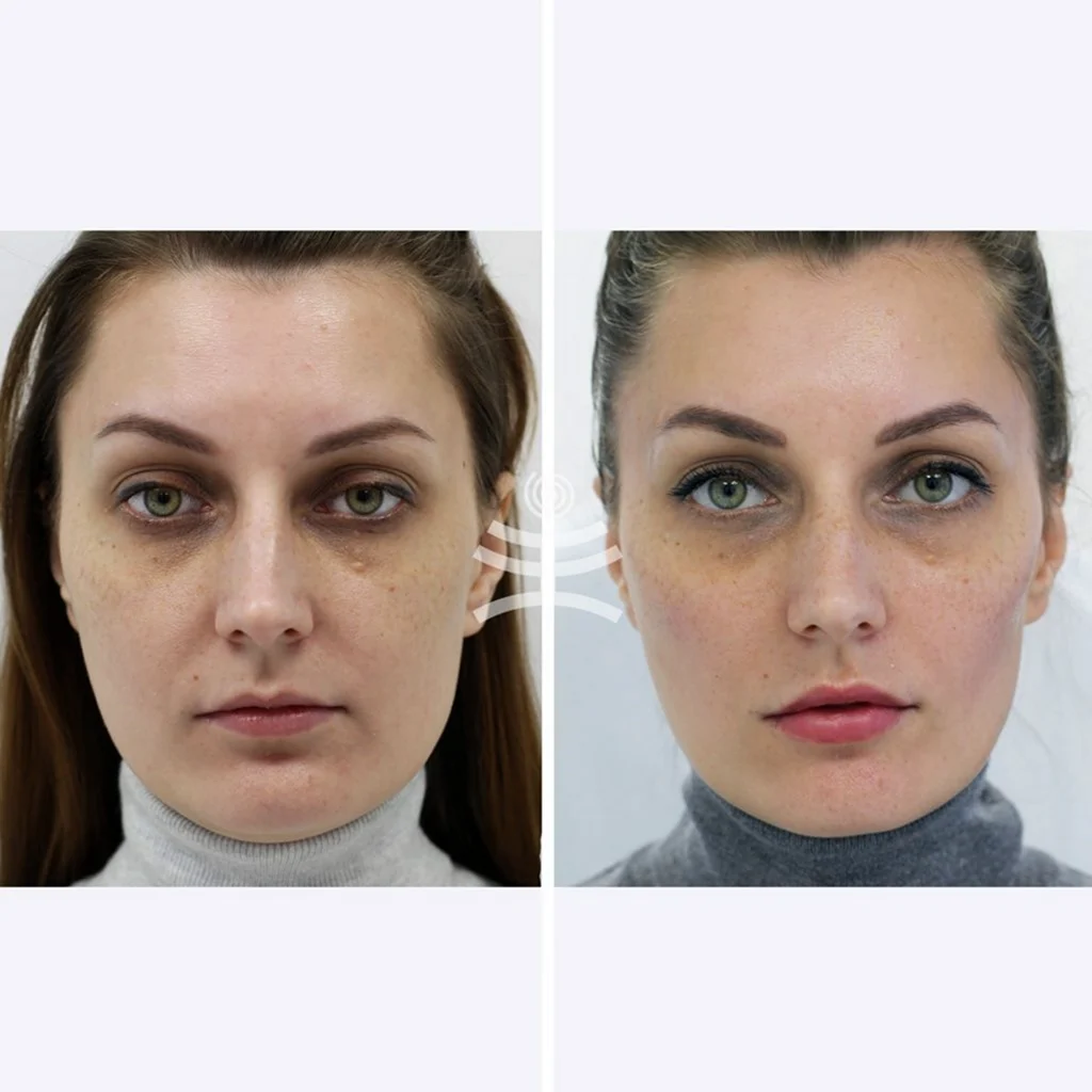 Контурная пластика скул