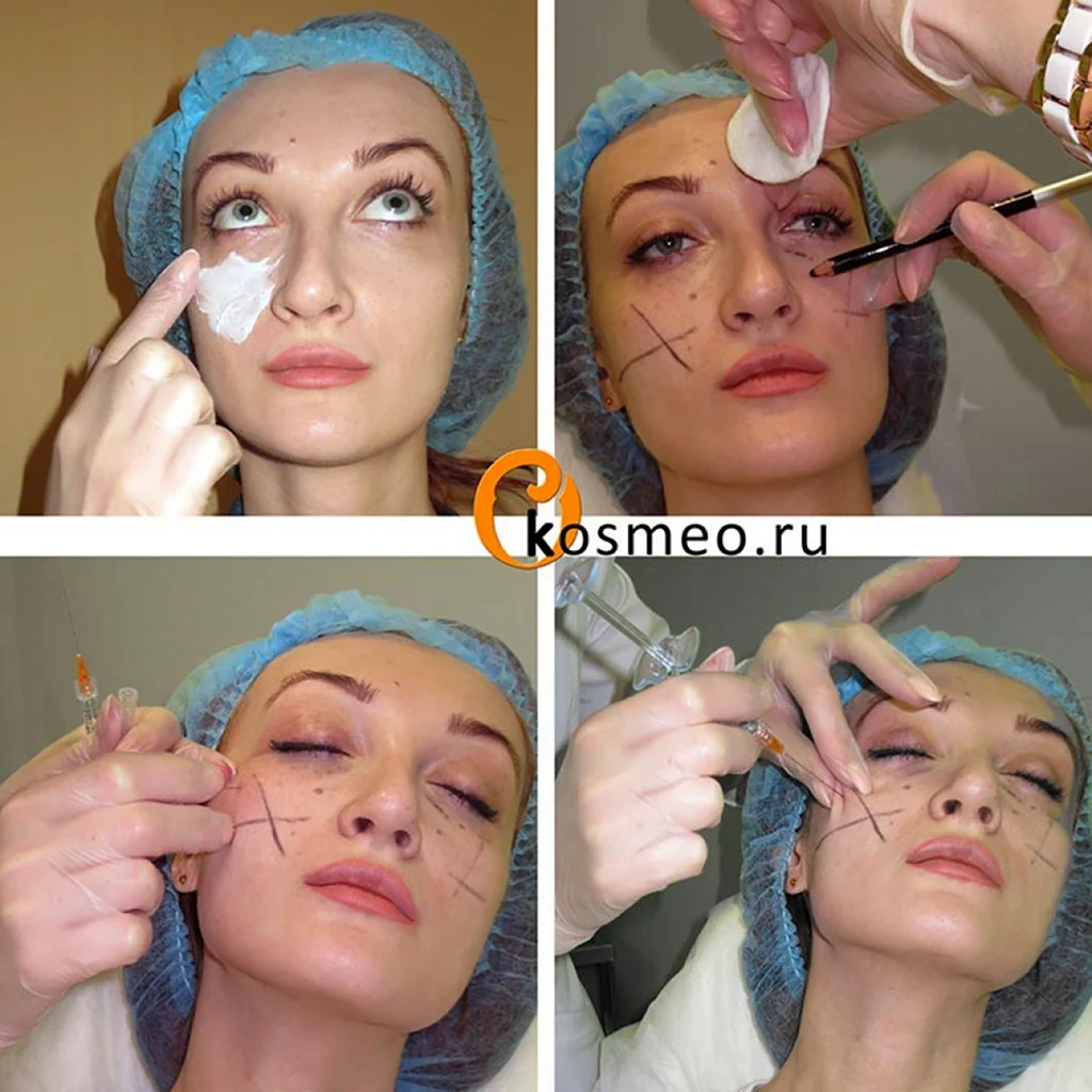 Коррекция скул филлерами