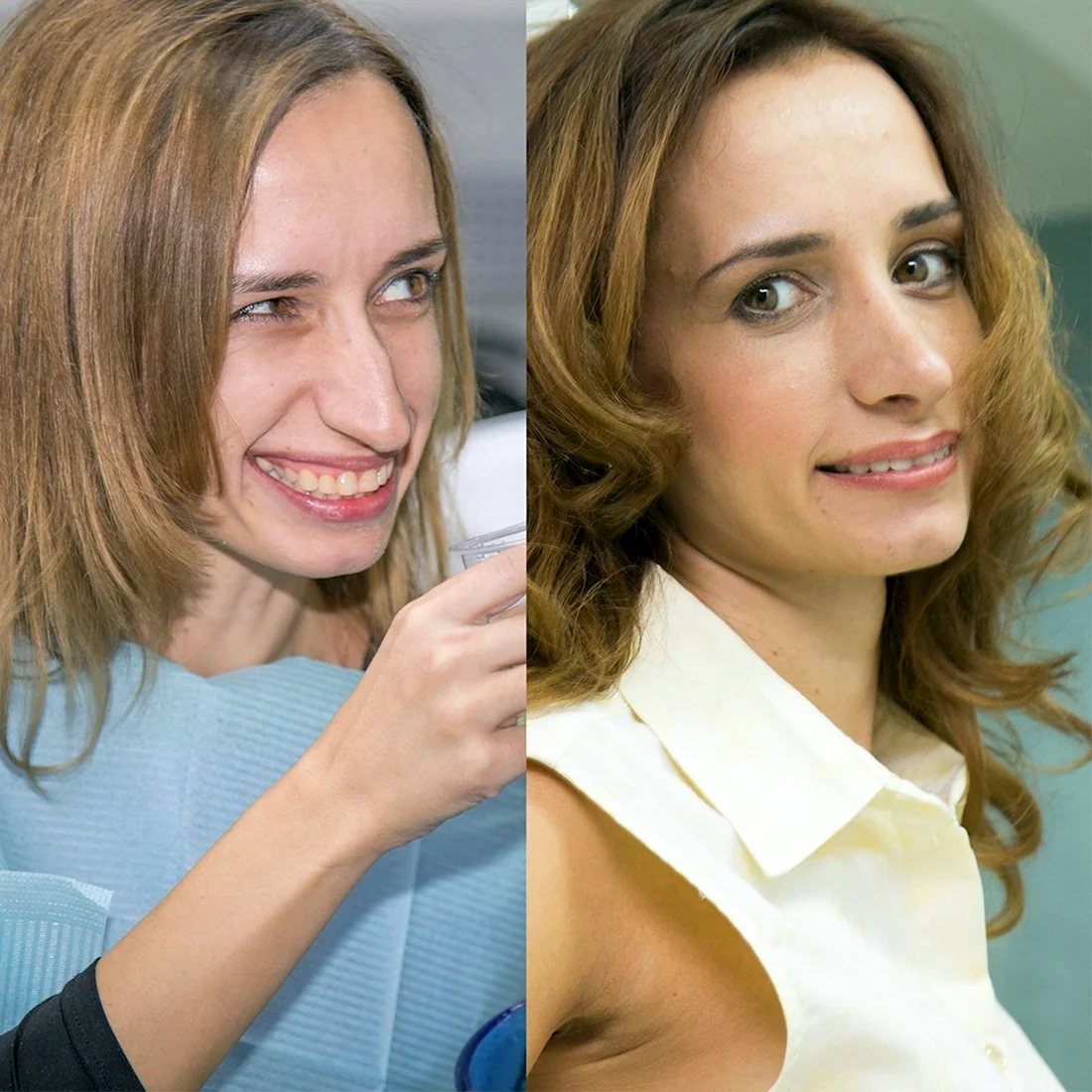 Кристина Шелест ринопластика