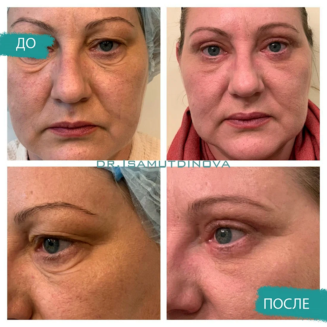 Круговая блефаропластика