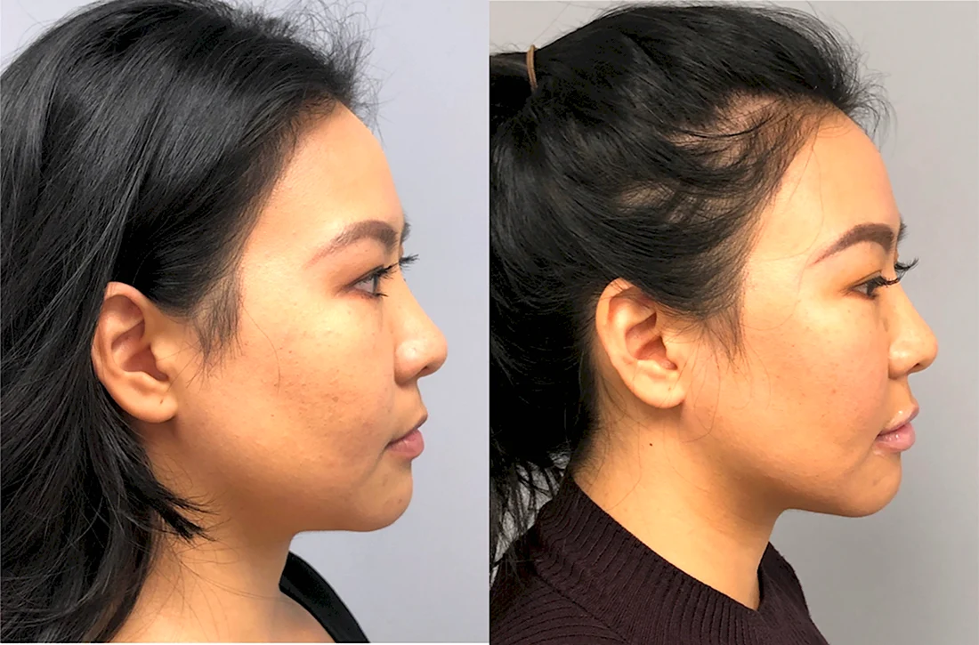Kybella