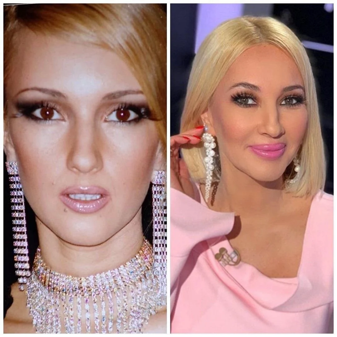 Лера Кудрявцева ринопластика