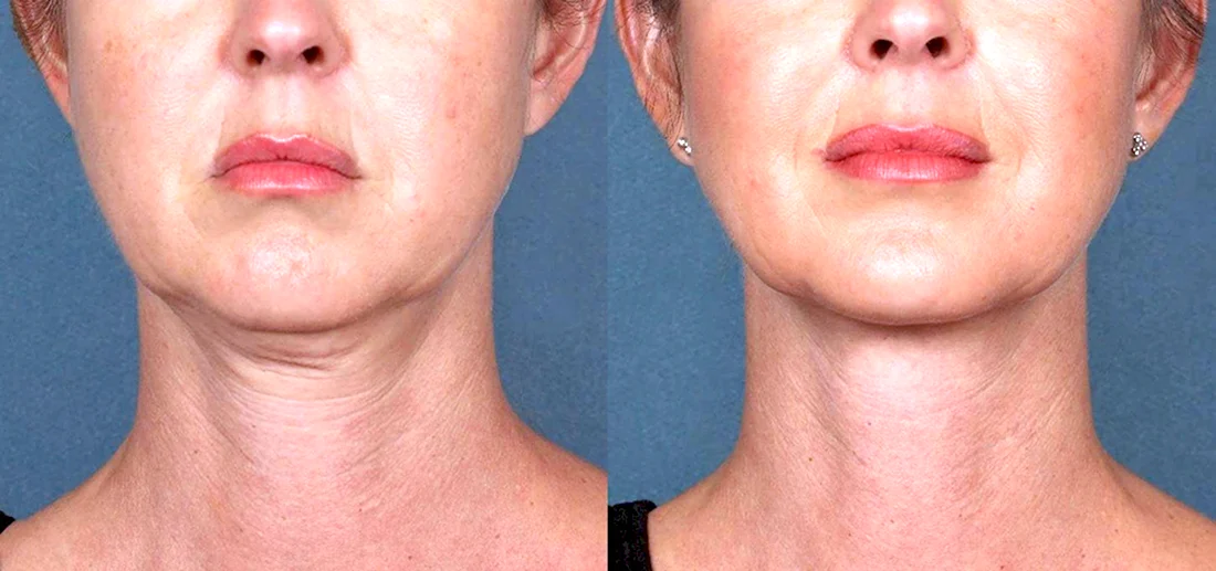 Липолитик для лица MESOSCULPT c71