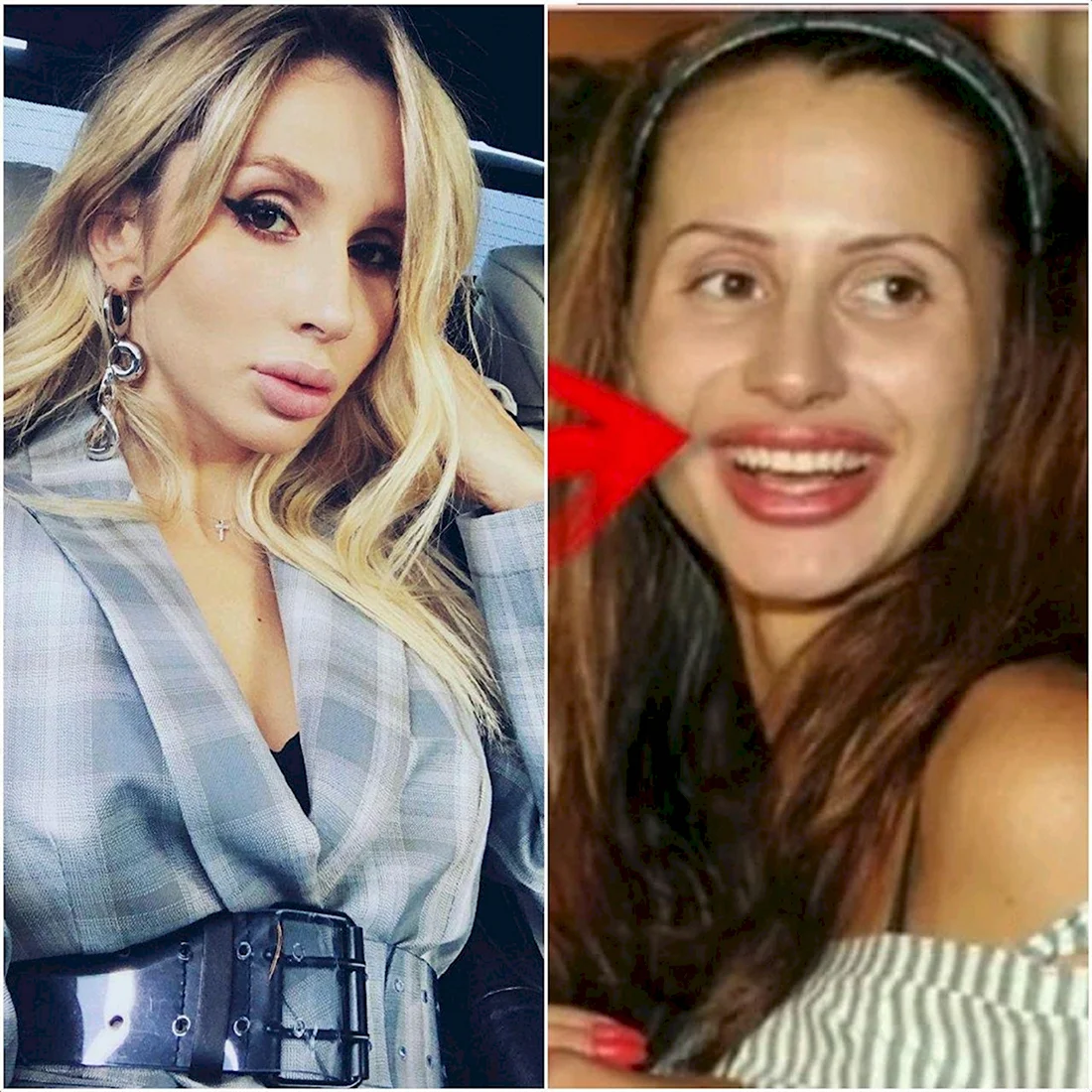 Лобода ринопластика