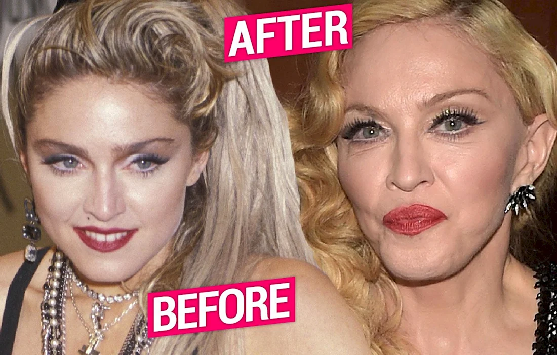 Madonna Plastic Surgery