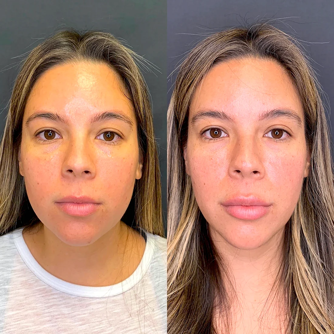 Masseter reduction