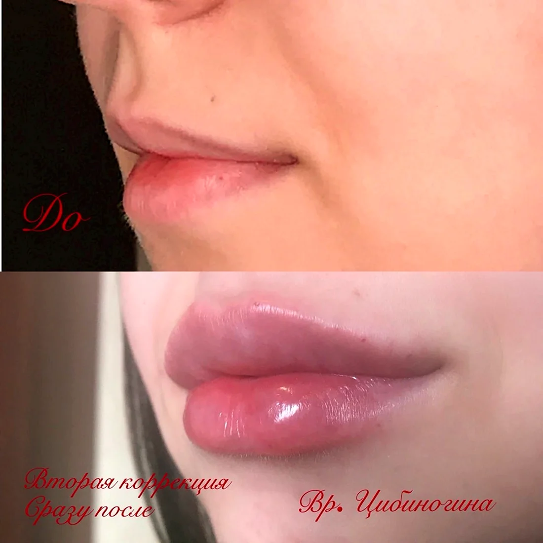 Напыление губ тонкие губы
