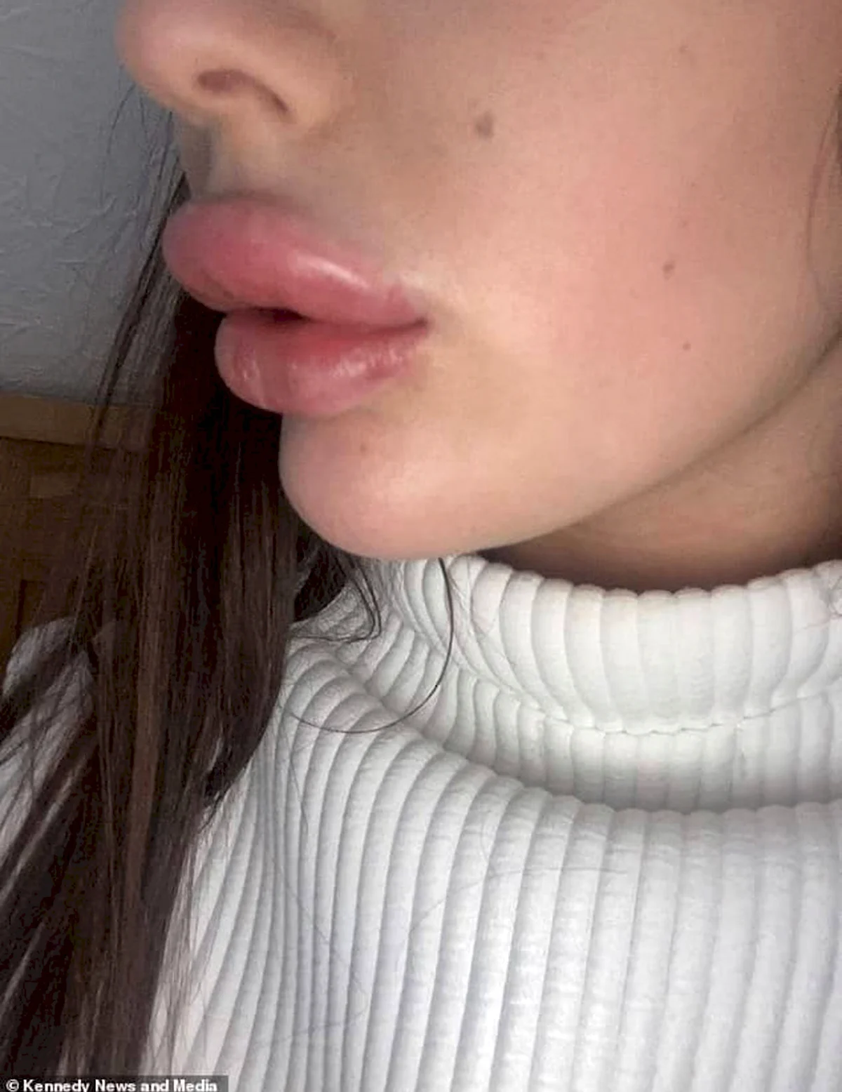 Неудачное увеличение губ
