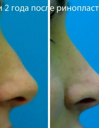 Нос после ринопластики по месяцам