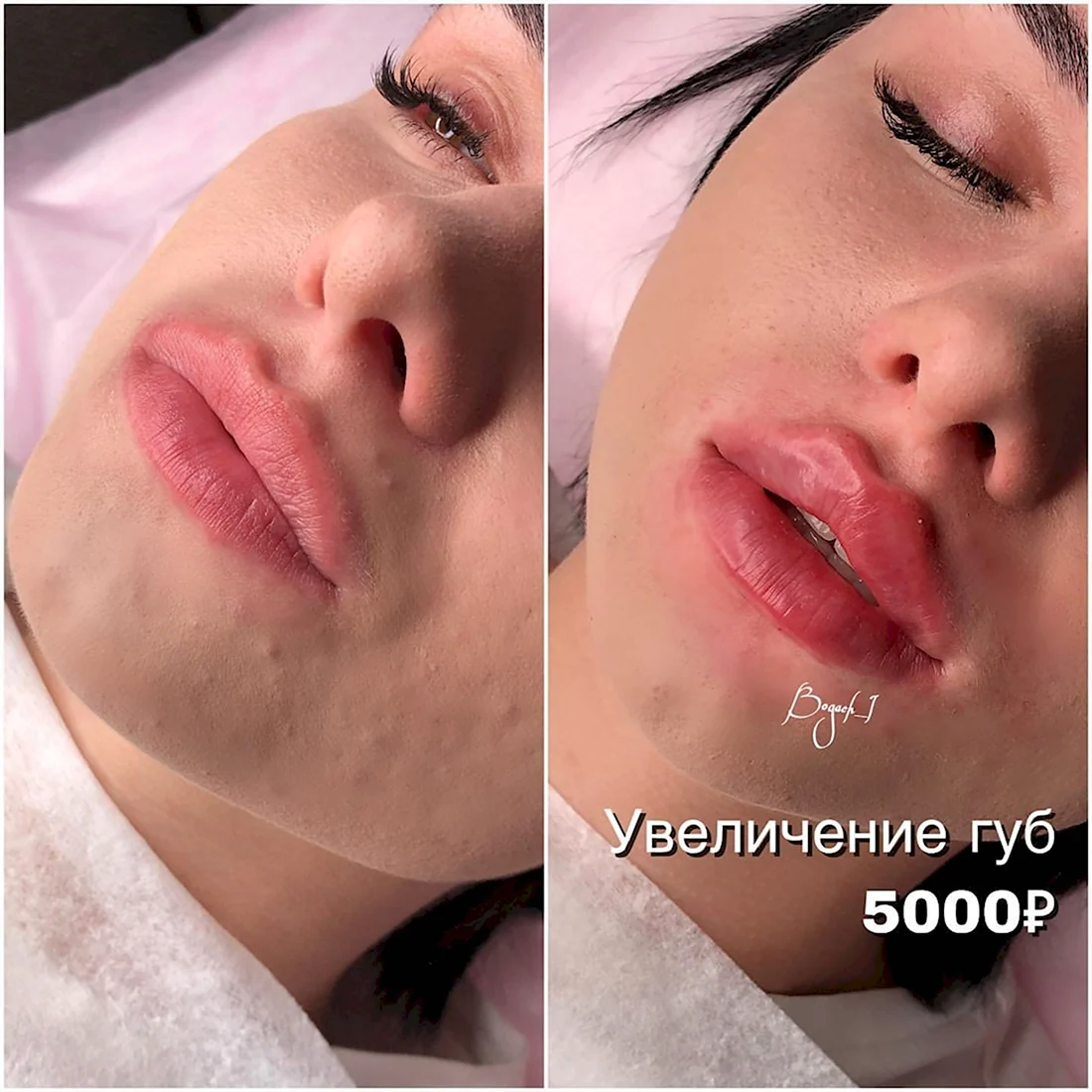 Парижская техника увеличения губ