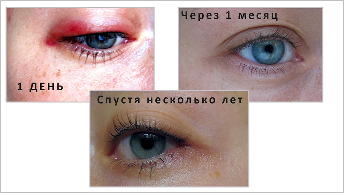 Перманентный макияж век межресничка заживление