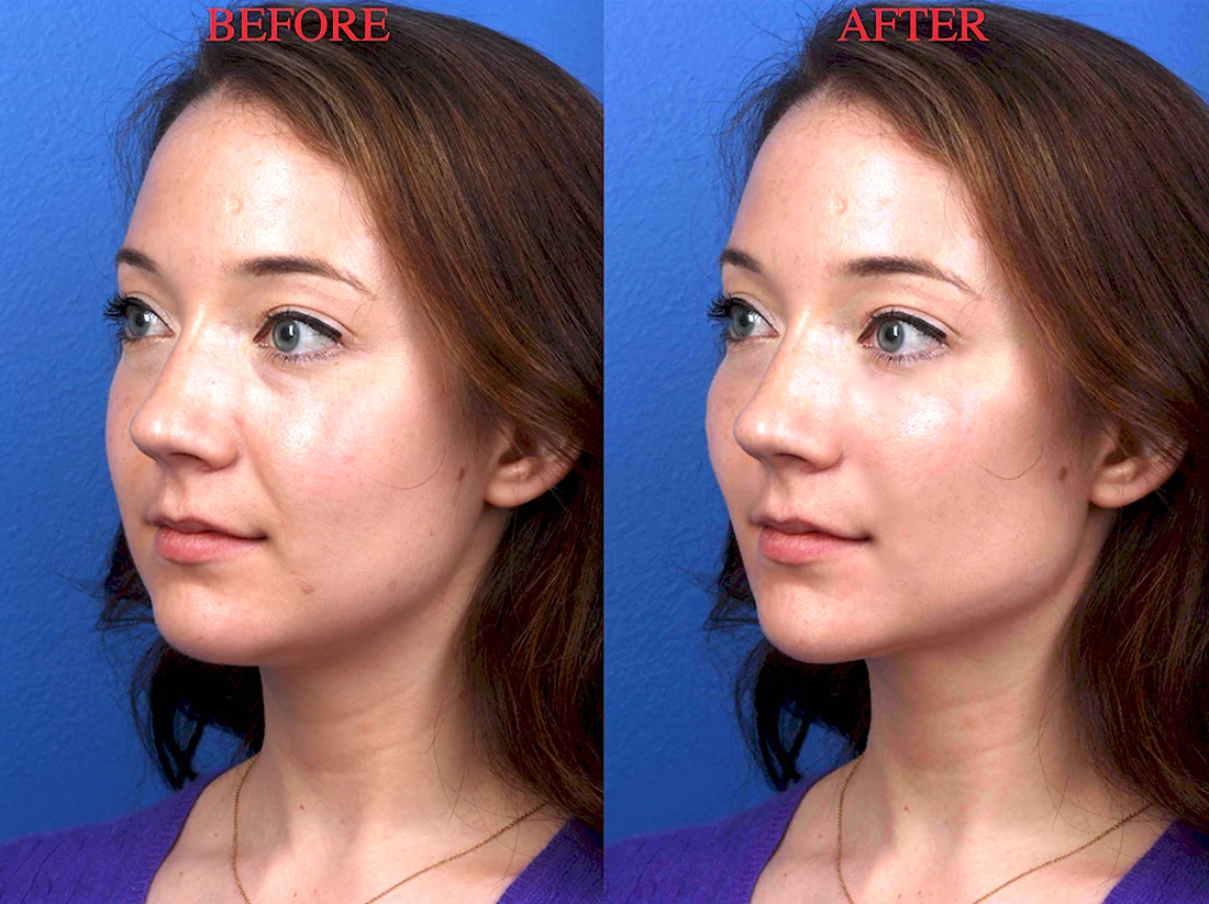 Plastic Surgery before and after