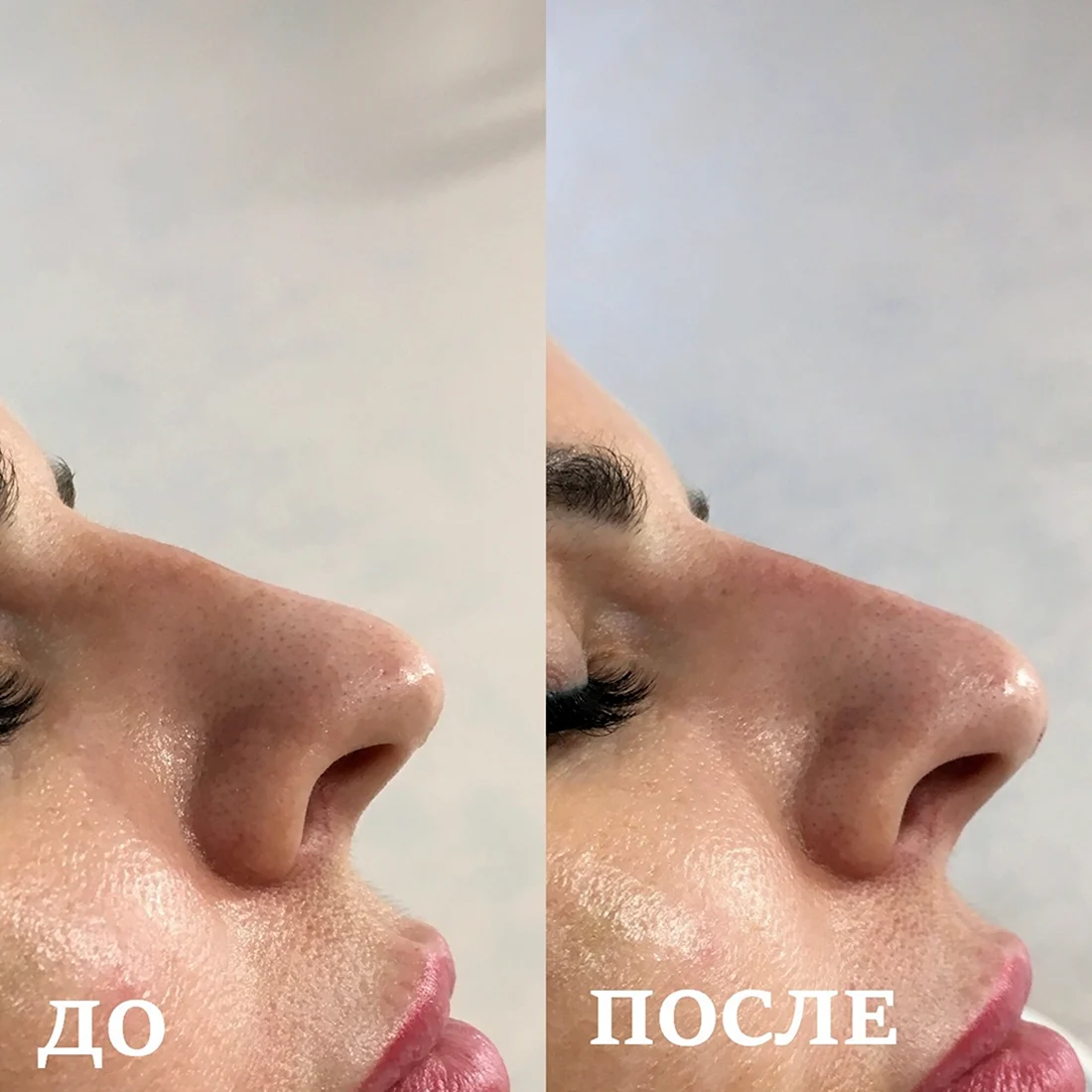 Последствия ринопластики филлером