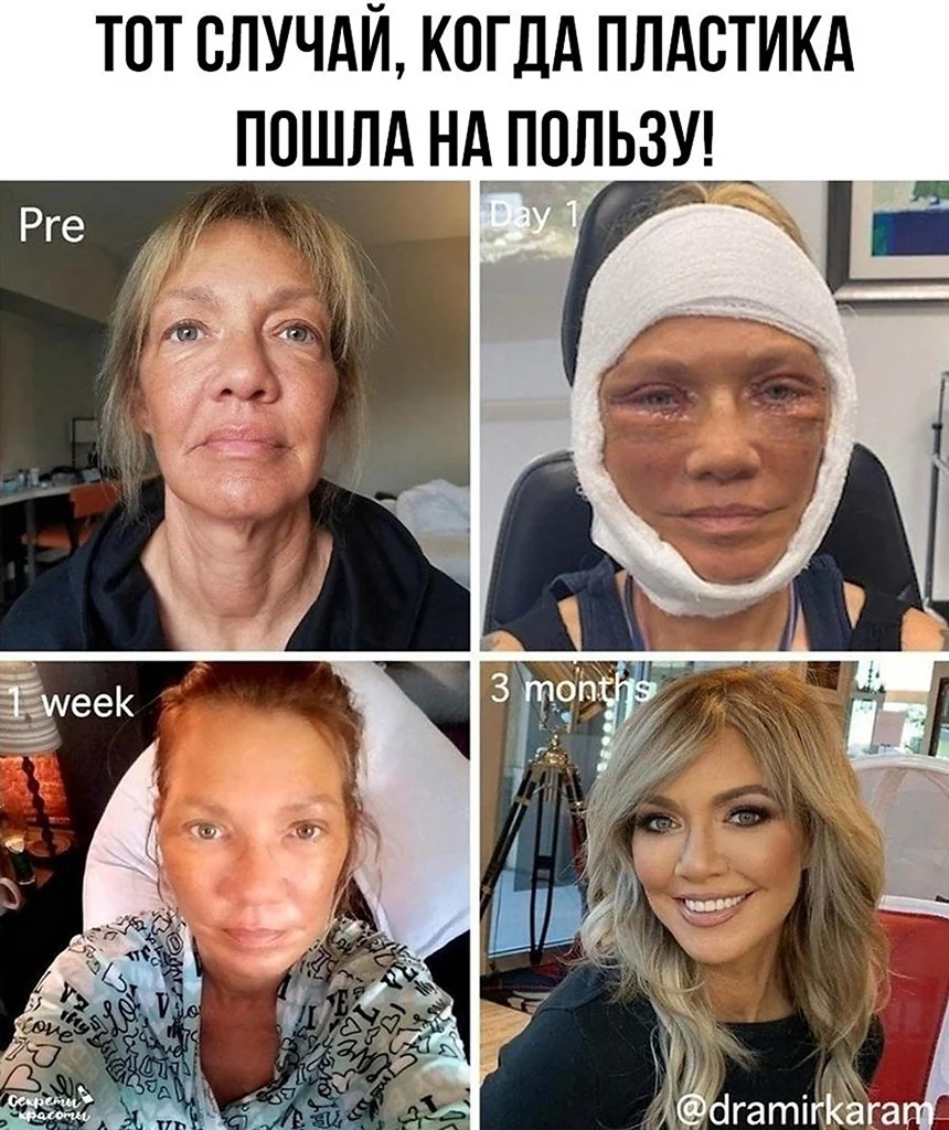 Преображение девушек после пластики