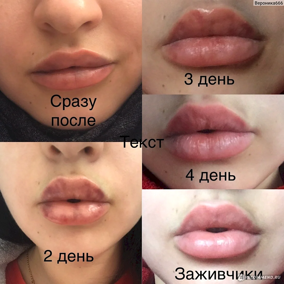 Препараты для увеличения губ