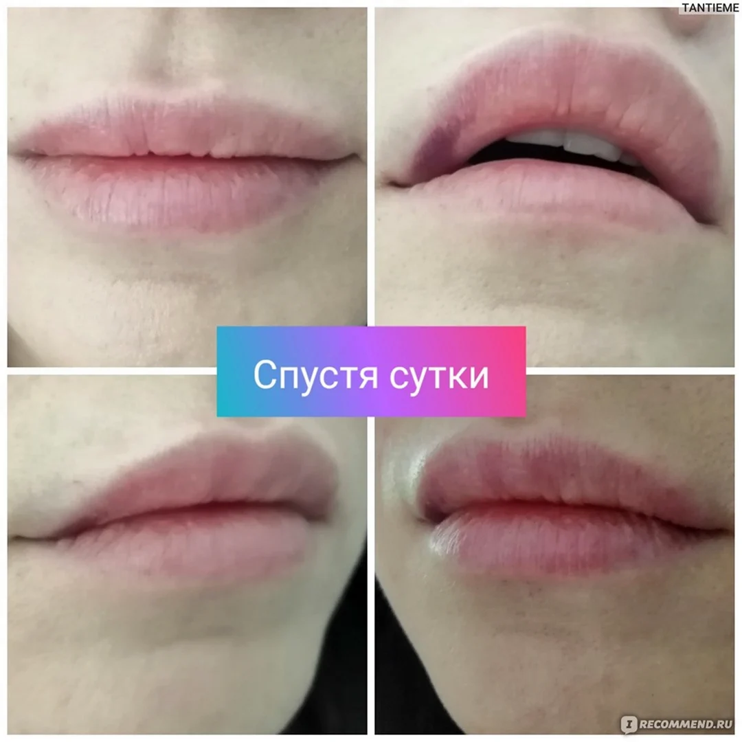 Препараты гиалуроновой кислоты для губ