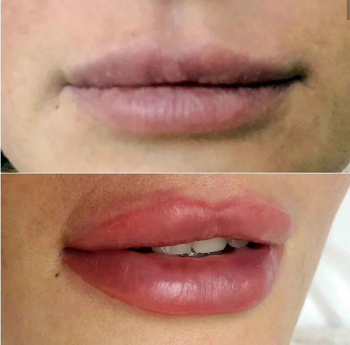 Рефрешинг губ гиалуроновой кислотой