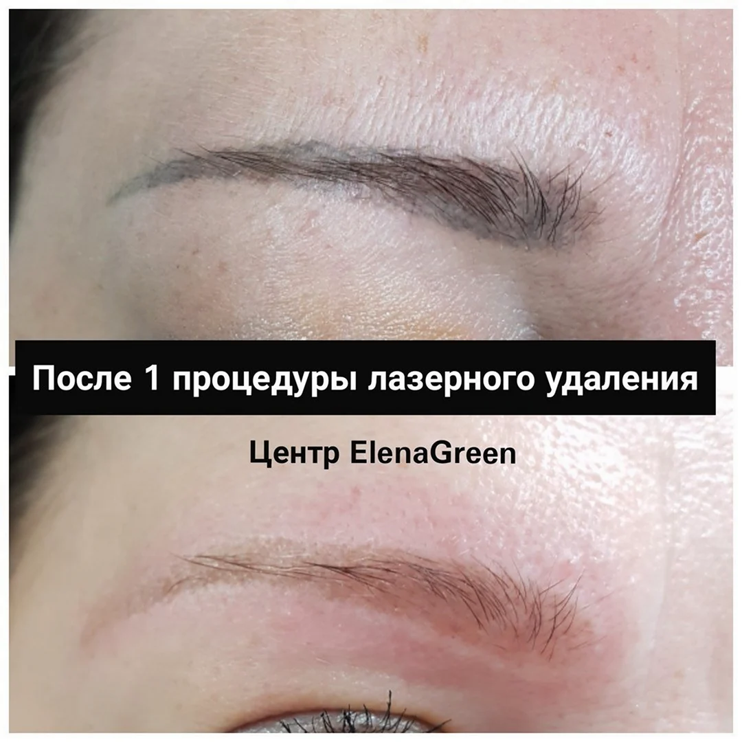 Ремувер для татуажа