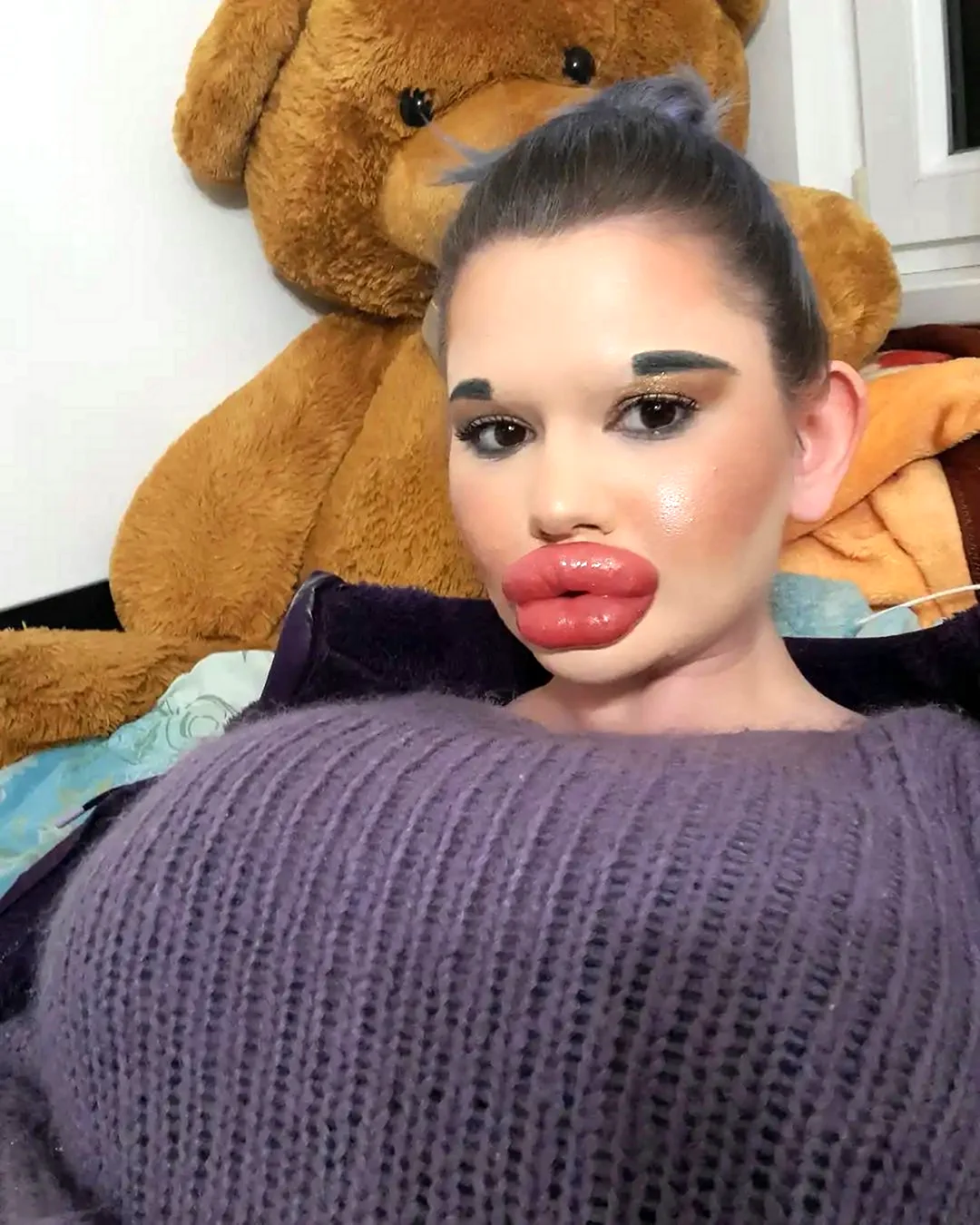 Самые большие губы в мире