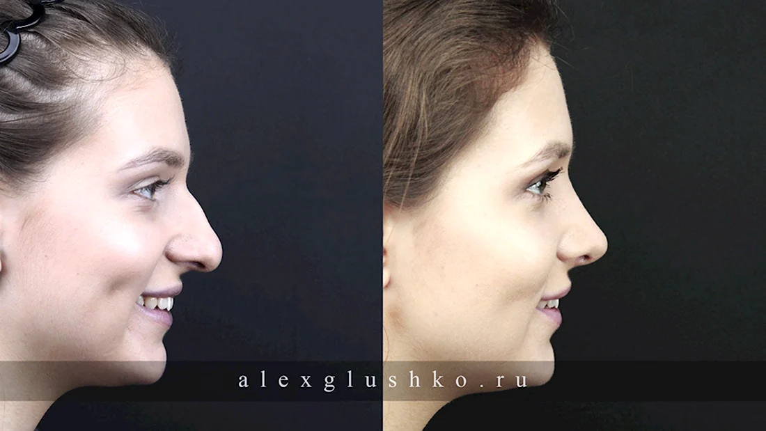 Седловидный нос ринопластика