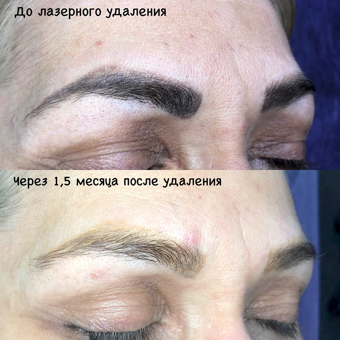 Сведение бровей лазером