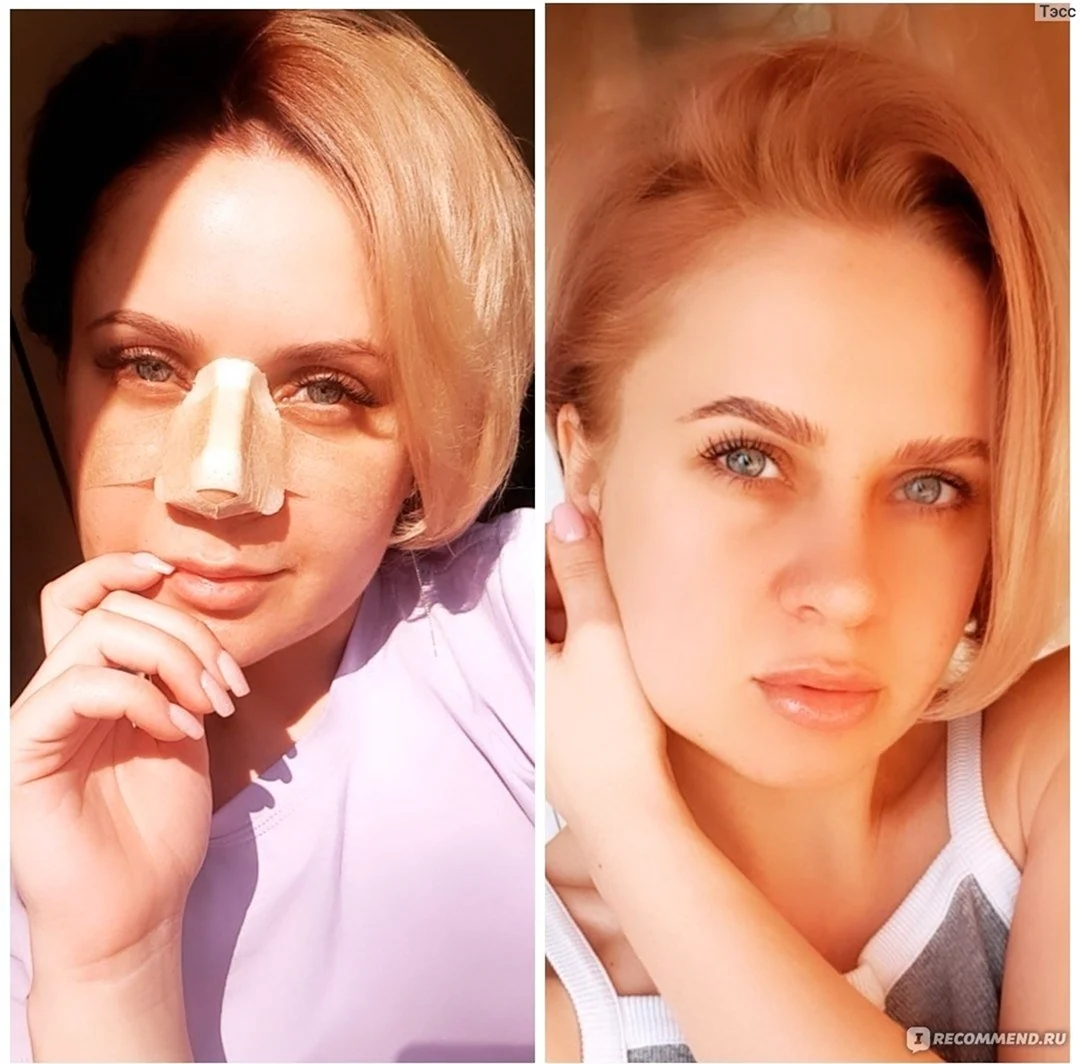 Светлана Иванова до ринопластики