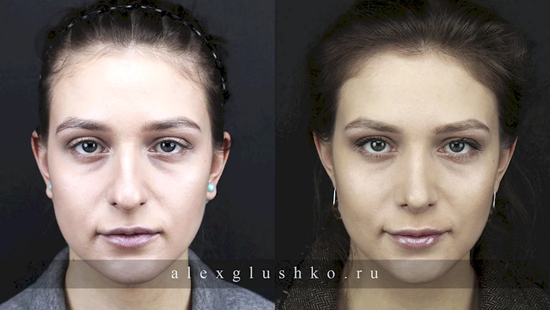 Светлана Иванова после ринопластики