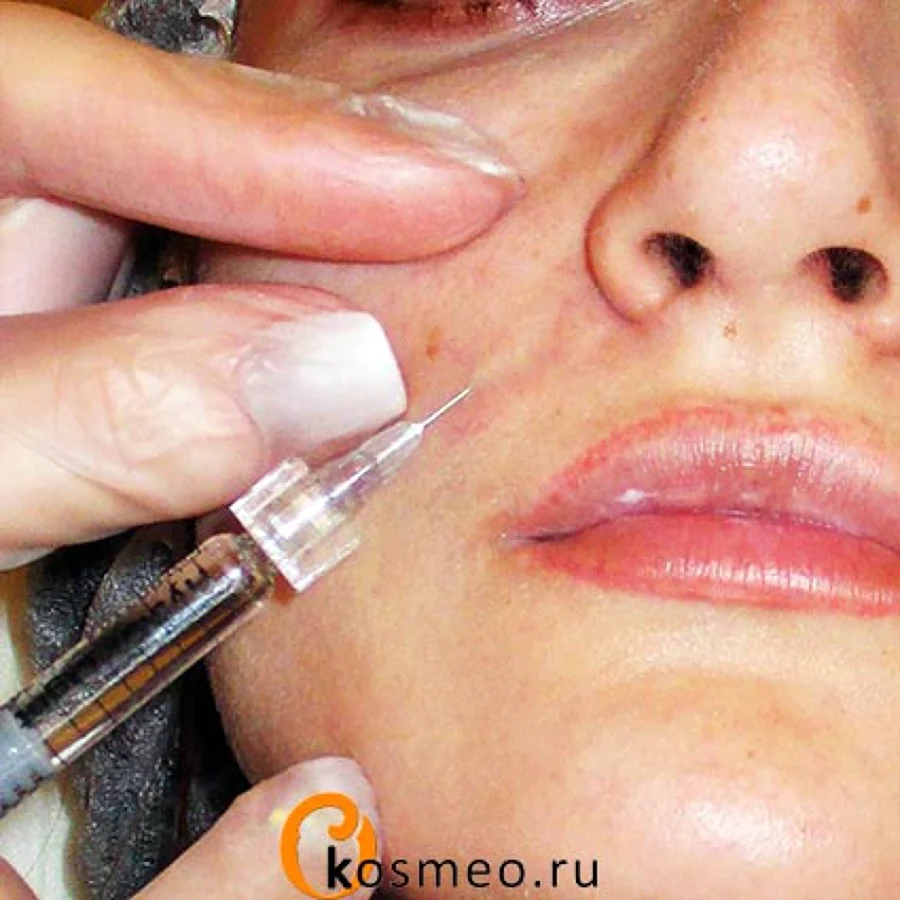Уколы в носогубные складки