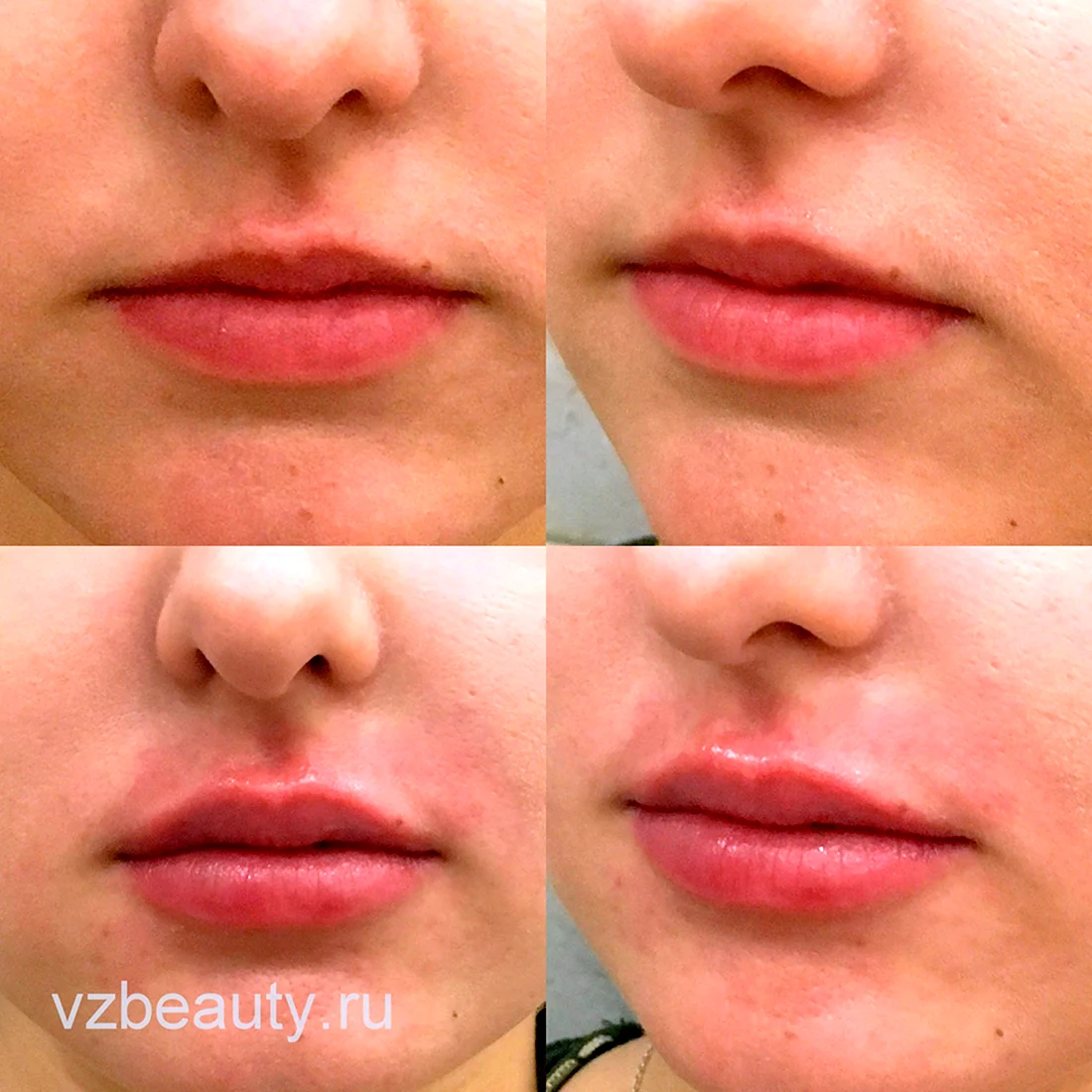 Увеличение губ до и после