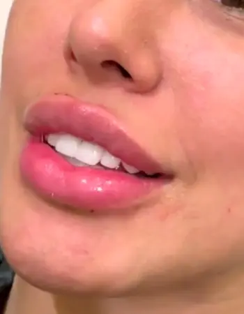 Увеличенные губы красивые