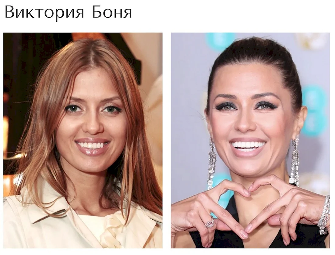 Виктория Боня виниры