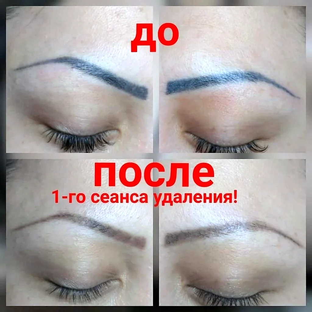 Выведение татуажа лазером
