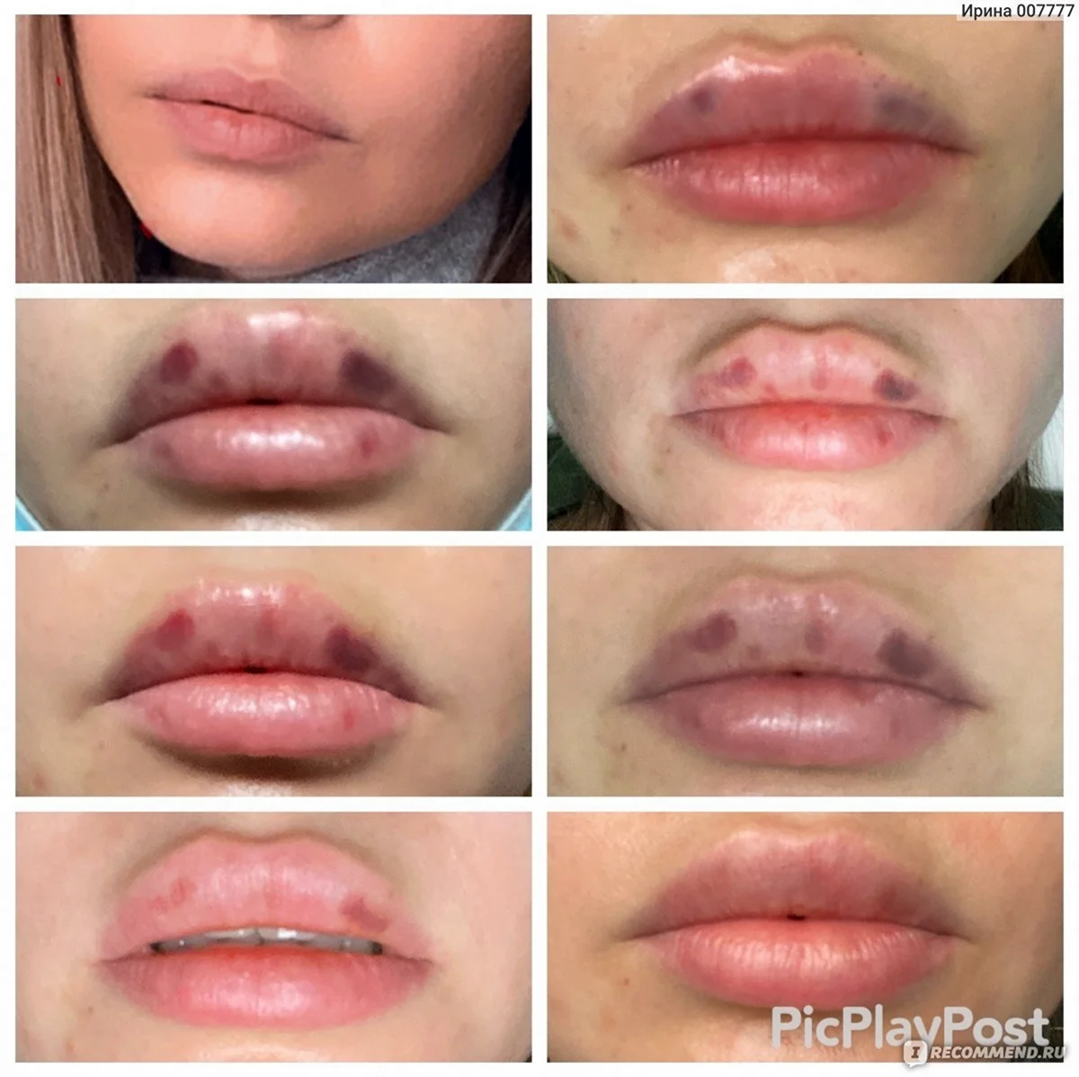 Зажившие губы 1мл гиалуронка