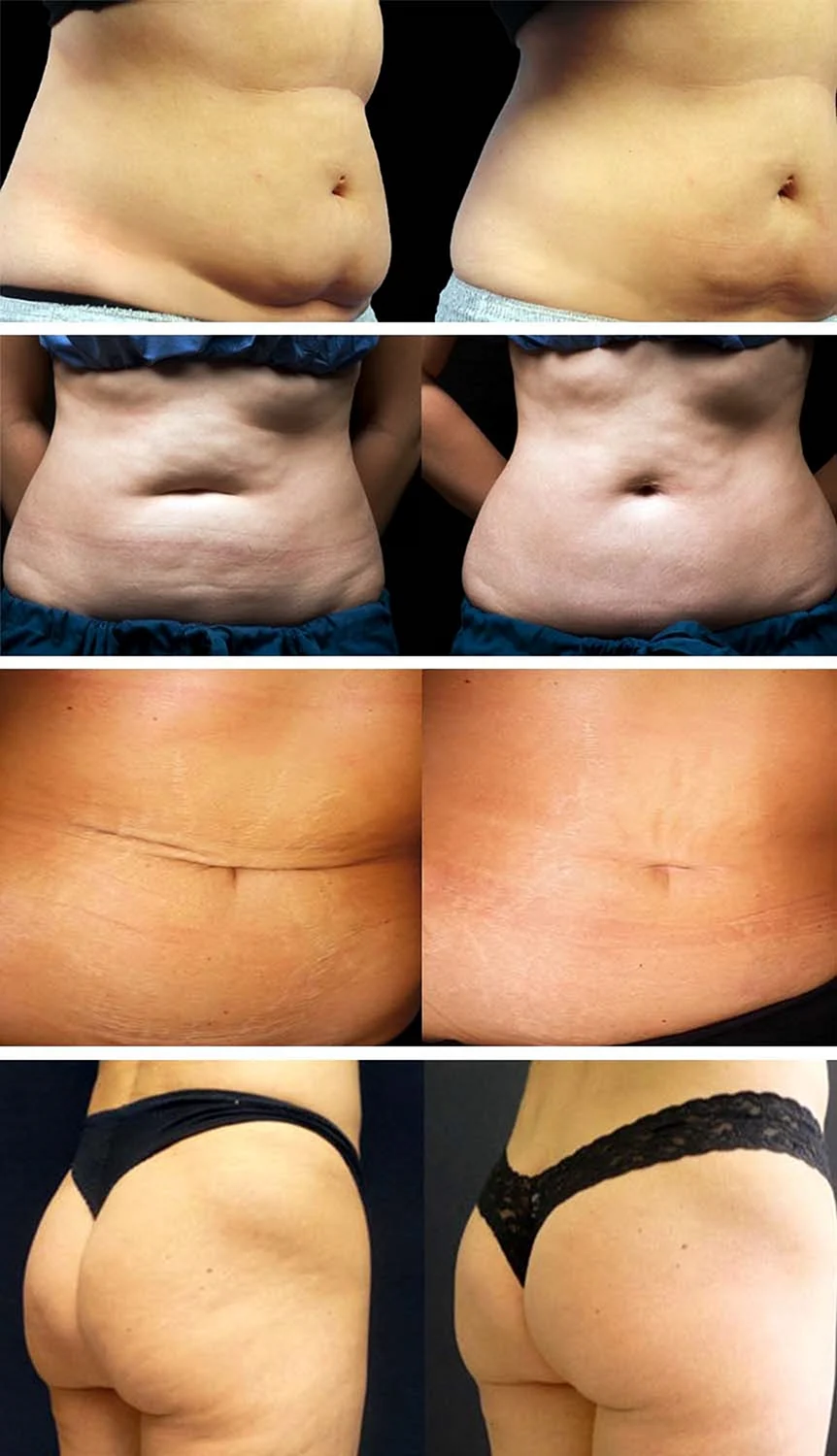 Кавитация 80к Lipo