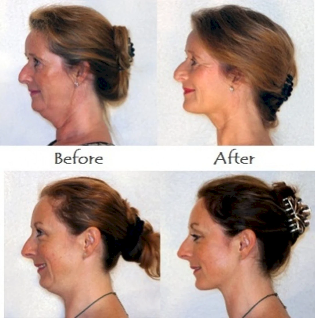 Тренажер для подбородка neckline Slimmer